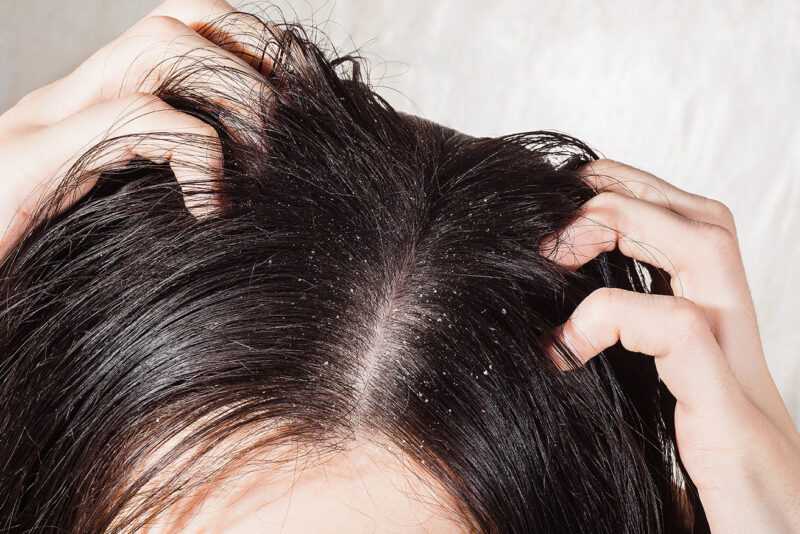 Tratamiento caída de cabello cuero cabelludo graso