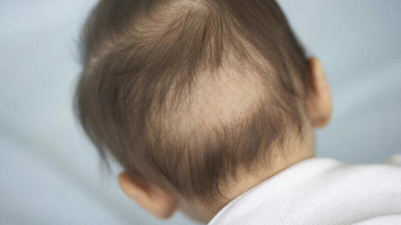 Causas de la caída de cabello en niños