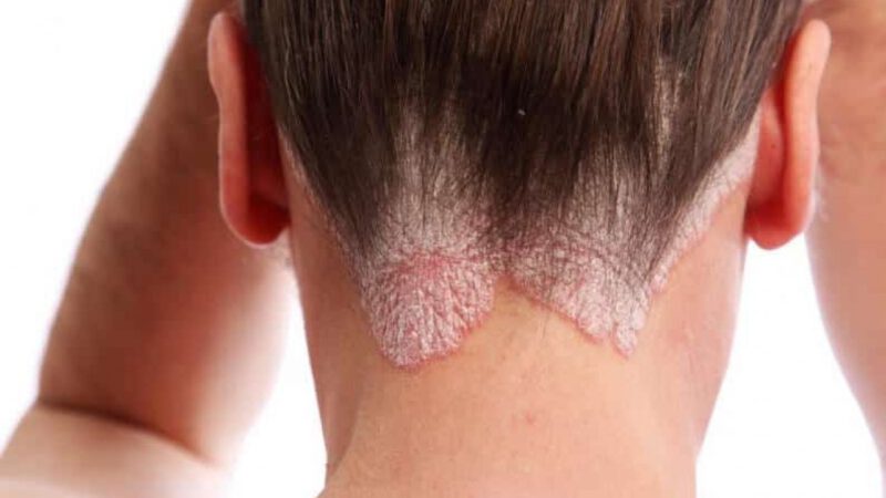 Dermatitis seborreica y la caída de pelo